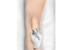 Minimally Invasive Knee Joint Replacement