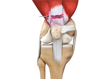 Quadriceps Tendon Rupture
