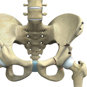 Periacetabular Osteotomy