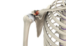 acromioclavicular-joint-arthritis