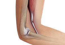 bicep-tendon-tear