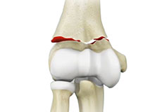 elbow-fracture