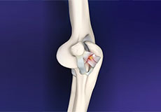 elbow-ligament-reconstruction
