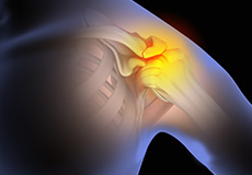 shoulder-impingement