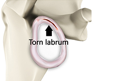 shoulder-labrum-tear