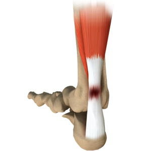 Achilles Tendinopathy