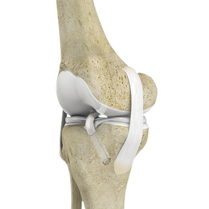 ACL Reconstruction