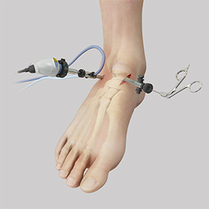 Ankle Arthroscopy
