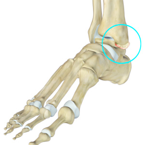 Ankle Impingement