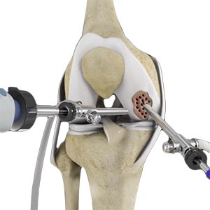 Arthroscopic Debridement