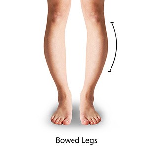 Bowed Legs