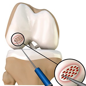 Cartilage Microfracture
