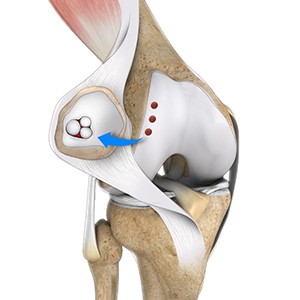 Cartilage Restoration of the Patellofemoral Joint