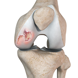 Chondral or Articular Cartilage Defects