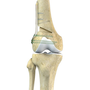 Distal Femoral Osteotomy