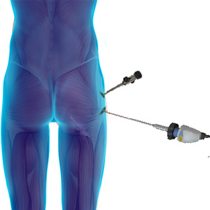 Endoscopic Surgery for Deep Gluteal Syndrome