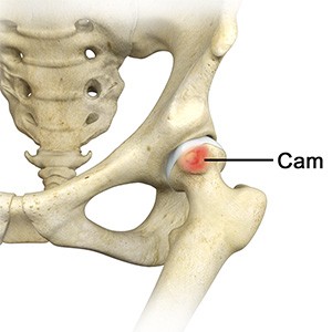 Femoral Cam Deformity
