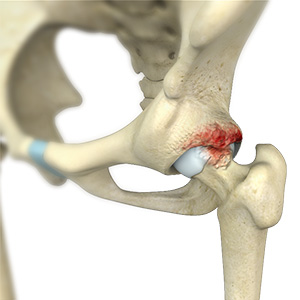 Femoroacetabular Impingement