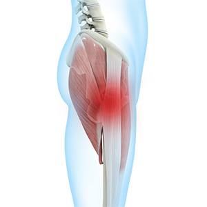 Greater Trochanteric Pain Syndrome