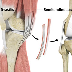 Hamstring Autograft