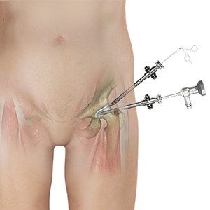 Hip Arthroscopy