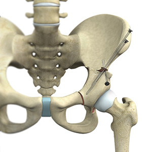 Hip Preservation Surgery