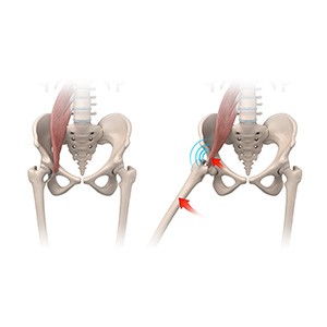 Iliopsoas Impingement