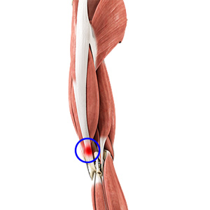 Iliotibial Band Lengthening