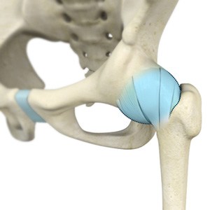 Ischiofemoral Impingement