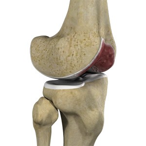 Knee Arthritis