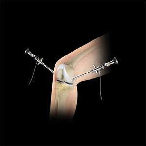  Knee Arthroscopy