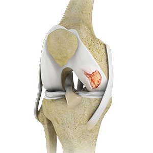 Knee Cartilage Restoration