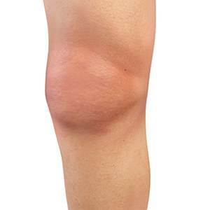 Knee Effusion