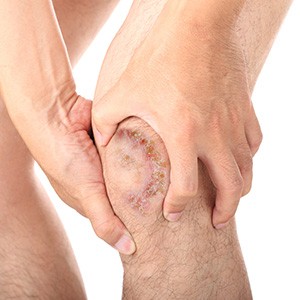 Knee Infection