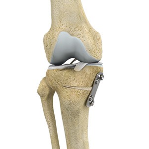 Knee Osteotomy