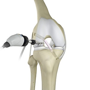 Knee Trauma Reconstruction