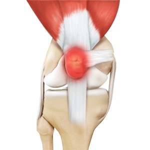 Kneecap Bursitis