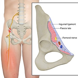 Lateral Femoral Cutaneous Nerve Decompression