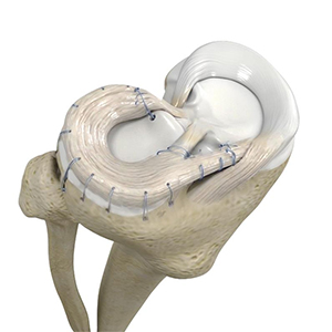 Meniscal Autologous Transplantation