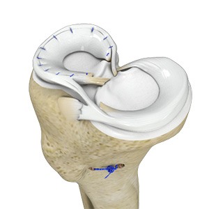 Meniscal Surgery