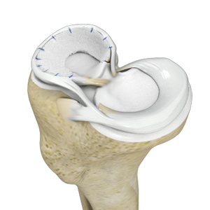 Meniscus Collagen Implant