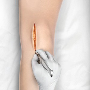 Minimally Invasive Knee Replacement