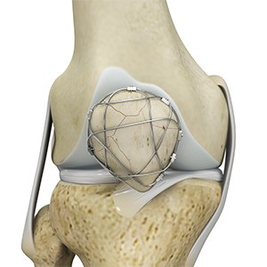 ORIF of the Knee Fracture