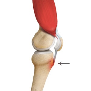Osgood Schlatter Disease