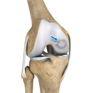 Osteochondritis Dissecans of the Knee