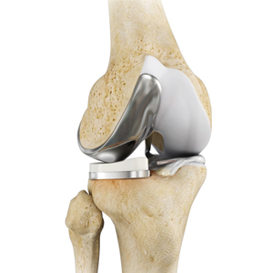 Unicompartmental/Partial Knee Replacement