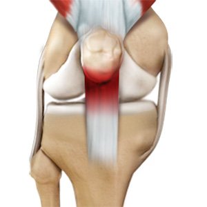 Patellar Tendinitis