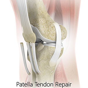Patellar Tendon Repair