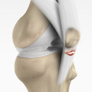 Patellar Tendon Rupture