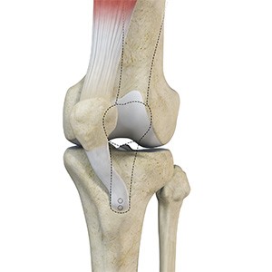 Patellofemoral Realignment